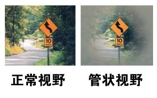 當青光眼遇上白內障，這場防盲保衛戰該怎么打？