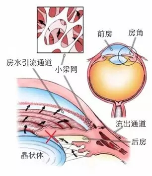 當青光眼遇上白內障，這場防盲保衛戰該怎么打？