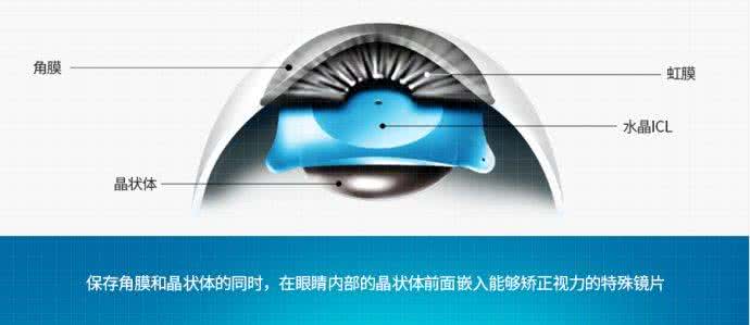 ICL高度近視的優(yōu)點