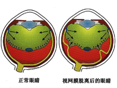 視疲勞可導(dǎo)致視網(wǎng)膜脫落？！