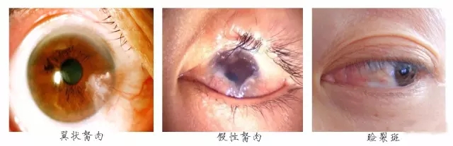 眼睛里長“肉”，當心翼狀胬肉！翼狀胬肉多少錢？