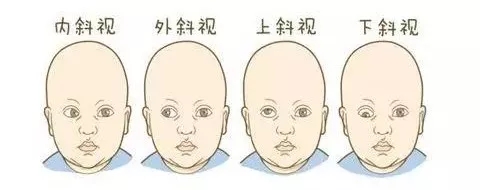 孩子斜視弱視不及時(shí)，導(dǎo)致毀一生？專(zhuān)家告訴您真相！